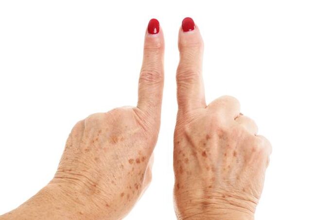 Artrosi deformante alle dita
