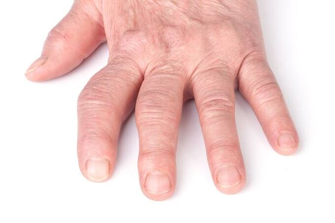 artrosi deformante alle mani