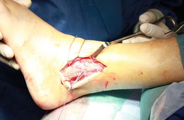 Chirurgia per l'artrosi della caviglia