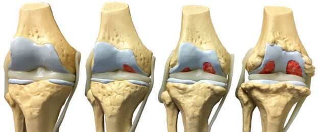 Danno articolare in vari stadi di sviluppo dell'artrosi della caviglia