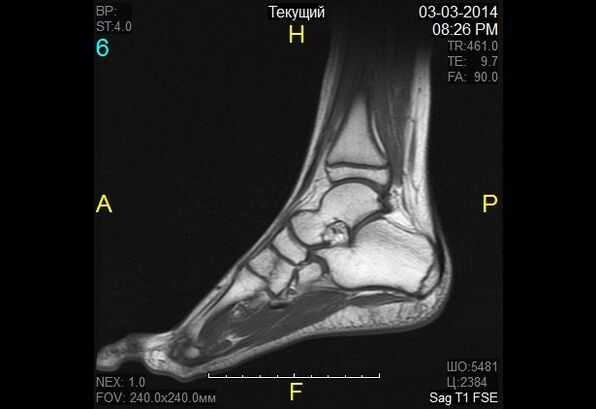 Immagine della caviglia nell'artrosi