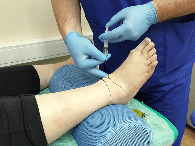 Puntura per l'artrosi della caviglia