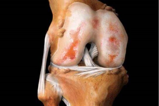 Danni all'articolazione del ginocchio con osteoartrite