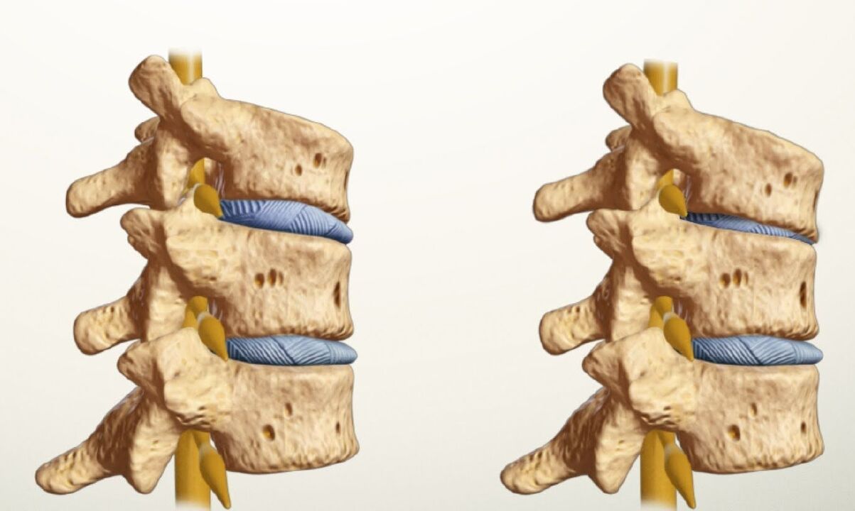 colonna vertebrale sana e malata con osteocondrosi lombare