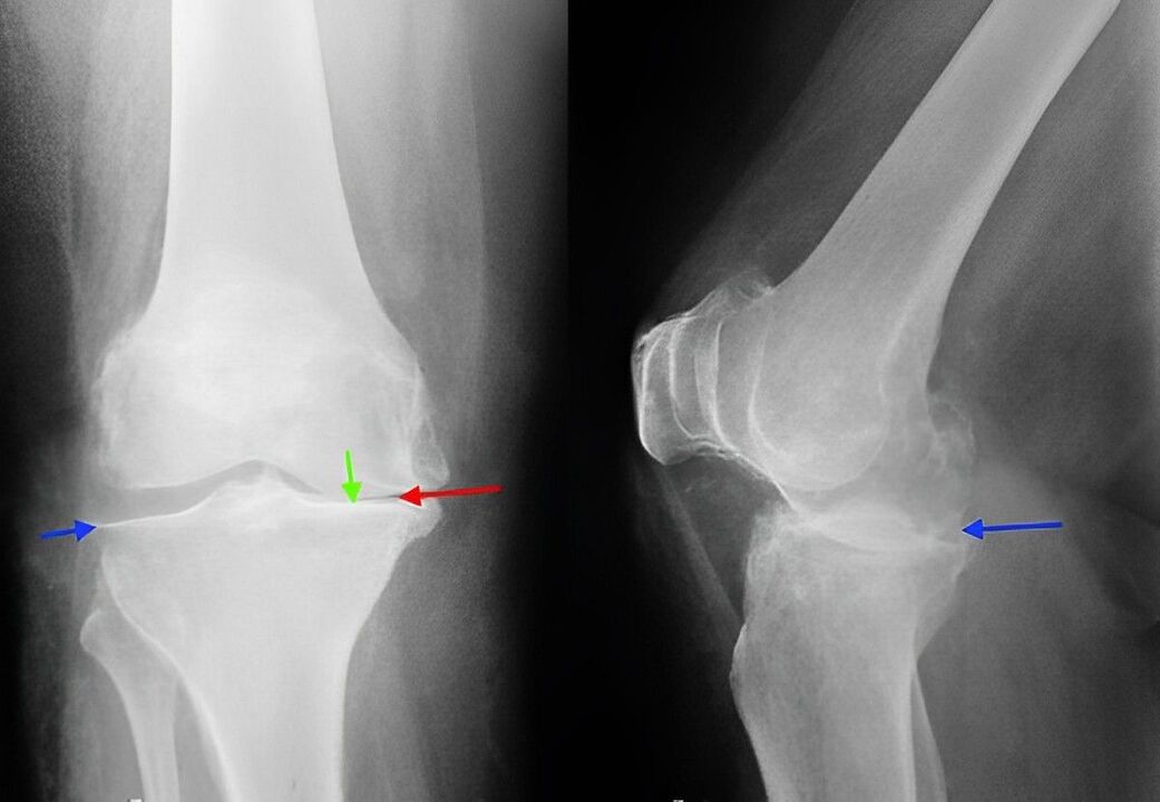 Immagine a raggi X dell'osteoartrosi dell'articolazione del ginocchio