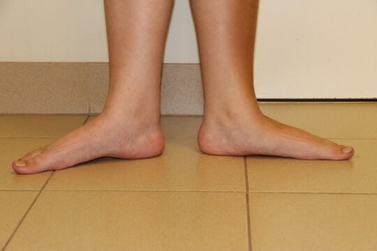 A volte i piedi piatti sono la causa dell’artrosi del collo