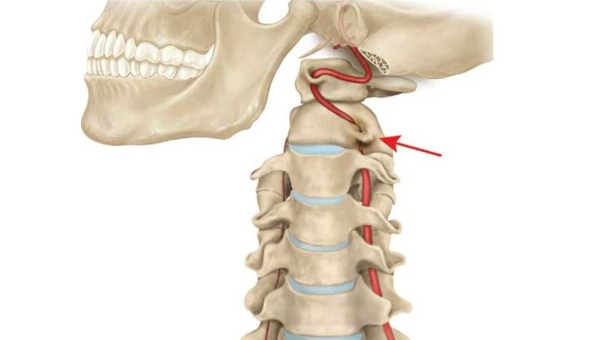Osteocondrosi del rachide cervicale