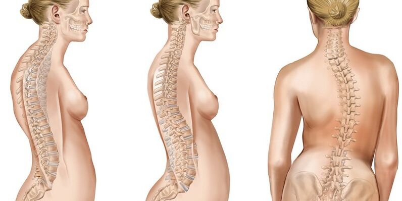 La scoliosi della colonna vertebrale toracica provoca dolore alle scapole