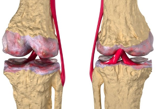 Osteoartrite del ginocchio