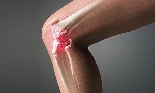 come l'artrite differisce dall'osteoartrite