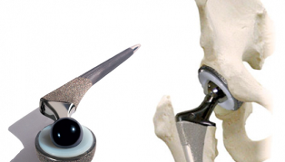 Endoprotesi dell'articolazione dell'anca nell'osteoartrosi