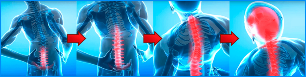 Stadi di sviluppo dell'osteocondrosi