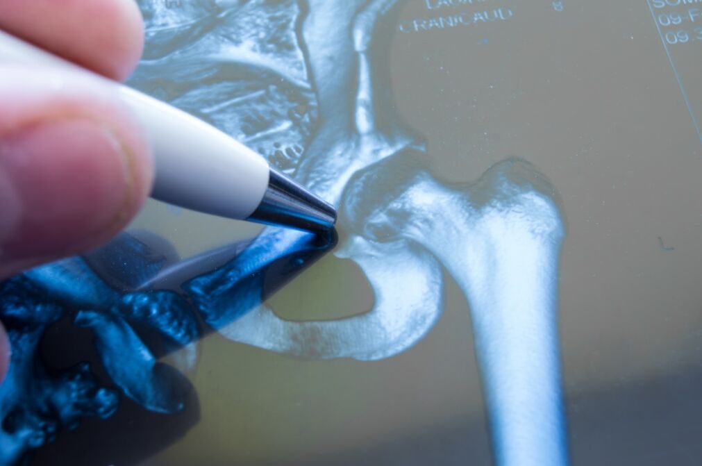 Artrosi dell'articolazione dell'anca sulla radiografia