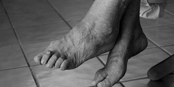 Artrosi della caviglia