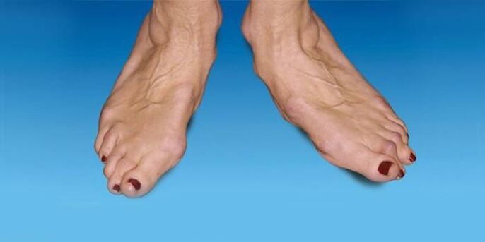 Malposizione del piede nell'artrosi della caviglia ankle