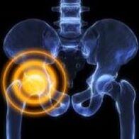 Artrosi dell'articolazione dell'anca