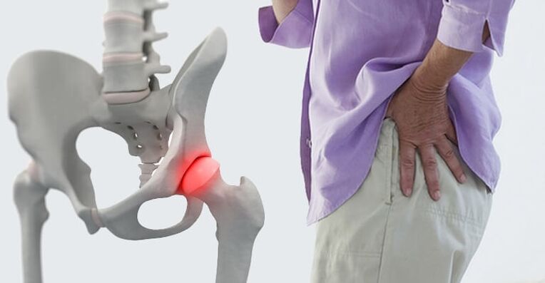 Dolore all'anca - un sintomo di artrosi dell'articolazione dell'anca
