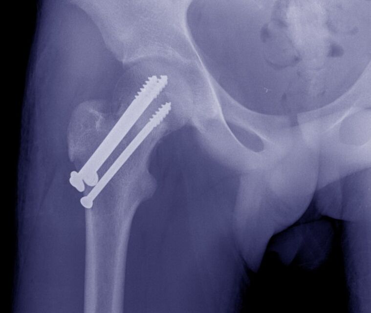 Radiografia dell'articolazione dell'anca, osteosintesi della frattura con fissatori interni